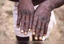 Can monkeypox cause a global pandemic?
