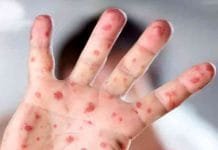 Monkeypox Outbreak in the Philippines: DOH Confirms Three New Cases