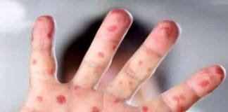 Monkeypox Outbreak in the Philippines: DOH Confirms Three New Cases