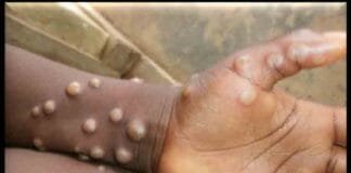 Monkeypox Crisis in Congo: More than 570 Dead – WHO Declares Global Health Emergency Congo monkeypox crisis