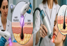 Laser Hair Removal: Popular Beauty Treatment, But Know These Possible Side Effects First Laser hair removal cosmetic treatment targeting hair follicles on skin